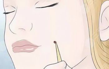 南京治疗色素痣的医院