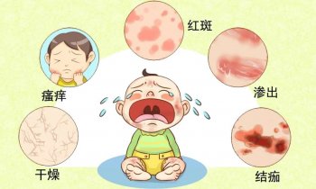 湿疹怎么快速治疗