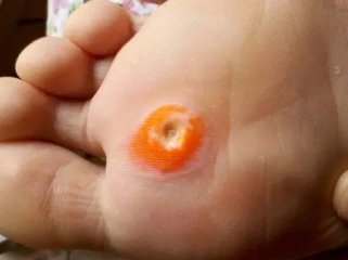 鸡眼跟跖疣的区别